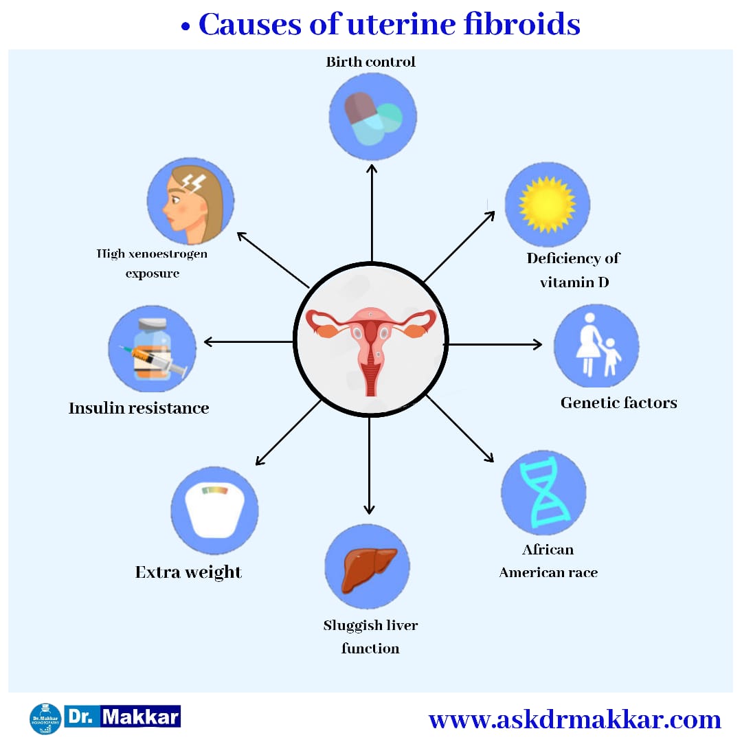 Uterine Fibroid Benign Tumour Myoma Causes Symptoms